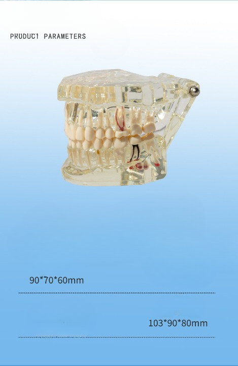 Removeable Dental Implant Model Set