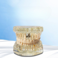 Removeable Dental Implant Model Set