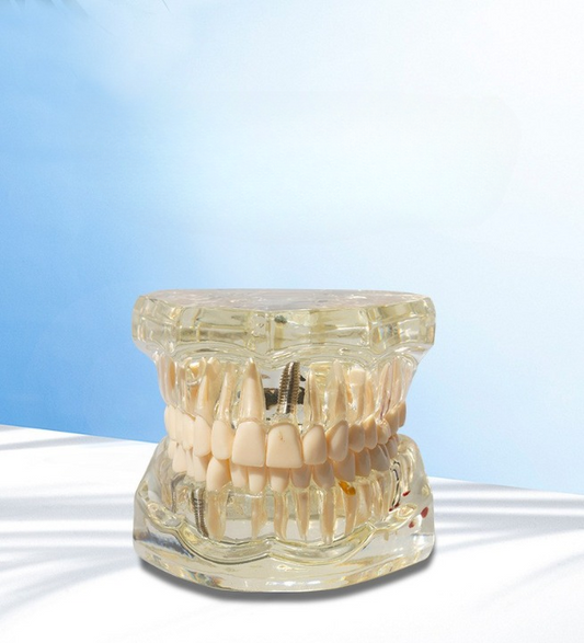 Removeable Dental Implant Model Set